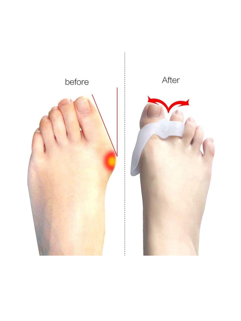 Bunion Supporter