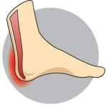 achillies-tendonitis