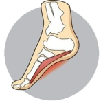 plantar-fasciitis