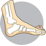 hammer-toes