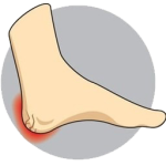 heel-fissures