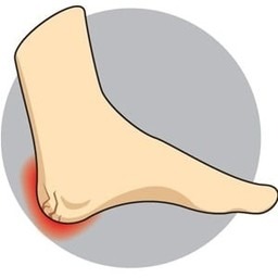 heel spur