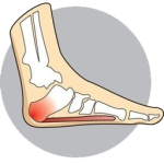 heel-pain