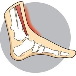 Lifebalance Foot Care | Shin Splints Shin splints