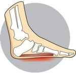 over-pronation