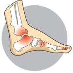 arthritis