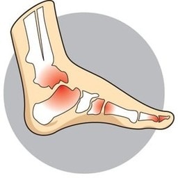 Lifebalance Foot Care | Arthritis Arthritis