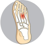 mortons-neuroma