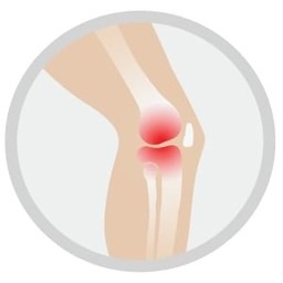 patellofemoral pain syndrome