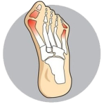 bunions