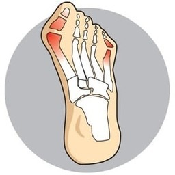 Bunions