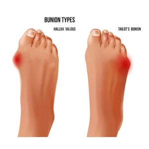 Step-by-Step-Instructions-for-Treating-Bunion-Pain-with-Insoles